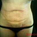 stomach lumps