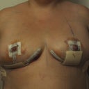 3 days post op