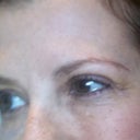 10 days post surgical. Still swollen, but much more lid showing!