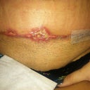 A little over 1 week PO, the first glance at the opening during a visit in the Dr's office. Yikes.