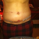 3 weeks, 3 days.  Much less swollen! Belly button is starting to sink in more and the opening is SO much smaller.  Finally, some positive changes!
