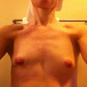 7 months post explant