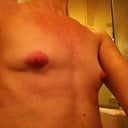 "tethered" scar on the right side