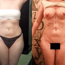 Day 5 post-BA and lipo. I haven't gotten the OK to shower yet, so I still have Dr. P's scribbles all over :)