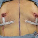 Right after my surgery.