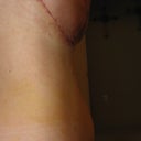 1 day post op