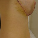 2 days post op