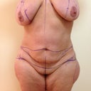 Pre Op Marking