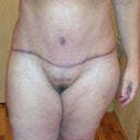 21 Days Post Op