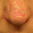 bump after restylane injection