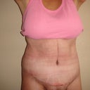 15 day PO