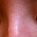 Taken 3 months after primary rhinoplasty to raise bridge of my nose. You can see how clearly my septum implant is visible...it never went away :(