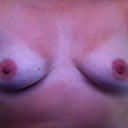 15 WEEKS POST OP - FRONT VIEW