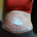 9days PO stitches