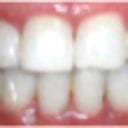 26 Yaer Old Female With A Cross Bite