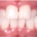 26 Yaer Old Female With A Cross Bite