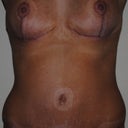 7 week post-op