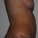 7 week post-op
