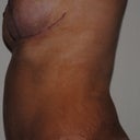 7 week post-op