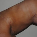 7 week post-op