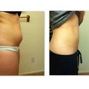 Before and After of my lower abs (Day 7)