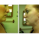 Before and After on my chin (Day 1)