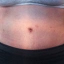 day 20 in the morning. Still swollen of course, but gets much worse in the afternoon.