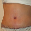 1 week post op front view - Swollen