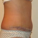 1 week post op side view - this looks like I did at about 12 weeks pregnant.