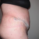 8 days PO, still very swollen