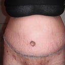 8 days PO, still swollen, but looking good!