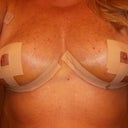 7 days post op