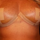 7 days post op new steri strips in place