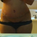 17 days post op