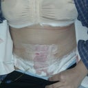 1 hour after surgery