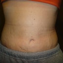 2 weeks PO.  My stretch marks look very transparent and I am very happy about that!