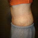 2 weeks PO side view