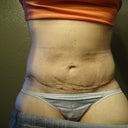 My incision is getting lighter!  I am still not using any scar treatment as of yet.  The wrinkle you see leading up to my belly button is from the compression garment.