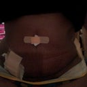 Front view, 13 days PO, notice the large hump near my waist...is that swelling or do you think it could be fluid build up?