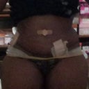 Front view, 13 days PO, notice the large hump near my waist...is that swelling or do you think it could be fluid build up?
