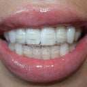 Heres an Invisalign brace in...invisible