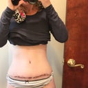26 days post op. The incision looks so red because I still have a glue-type strip over the incision that hasn't peeled off yet. There is dried blood and whatnot stuck under it so that's why the incision looks like that. Doc told me not to "pull" it off, just let it fall and flake off naturally. I guess it likes being on my belly :0(