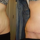 look at where the mole was before/after!! crazy!!