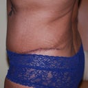 After TT @ 6 wks
