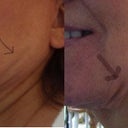 Creases and folds in  cheek, jaw and under chin