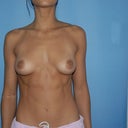 Before any plastic surgery