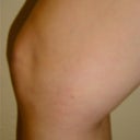 34 Year Old Female With Spider Veins
