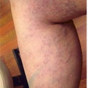 34 Year Old Female With Spider Veins
