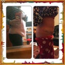 before tt and 19 days post op