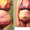 Before and PO day 8 comparison in bikini
